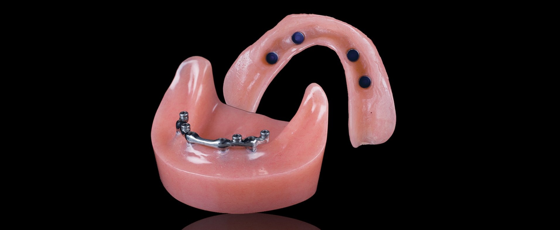 Протез на имплантах при полном отсутствии. Балочный протез на 4 имплантах. Внутрикорневой аттачмент. Балочная система крепления бюгельных протезов. Съемный протез (6-14 зубов) термо Джет.
